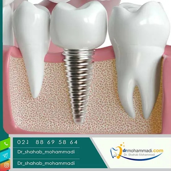 توصیه&zwnj;های قبل و بعد از عمل ایمپلنت